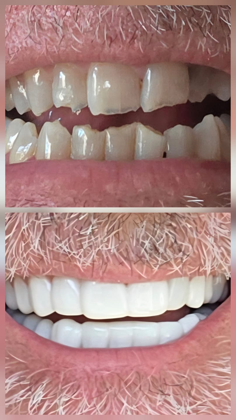 Customer photo review of Click-in Veneers 4.0