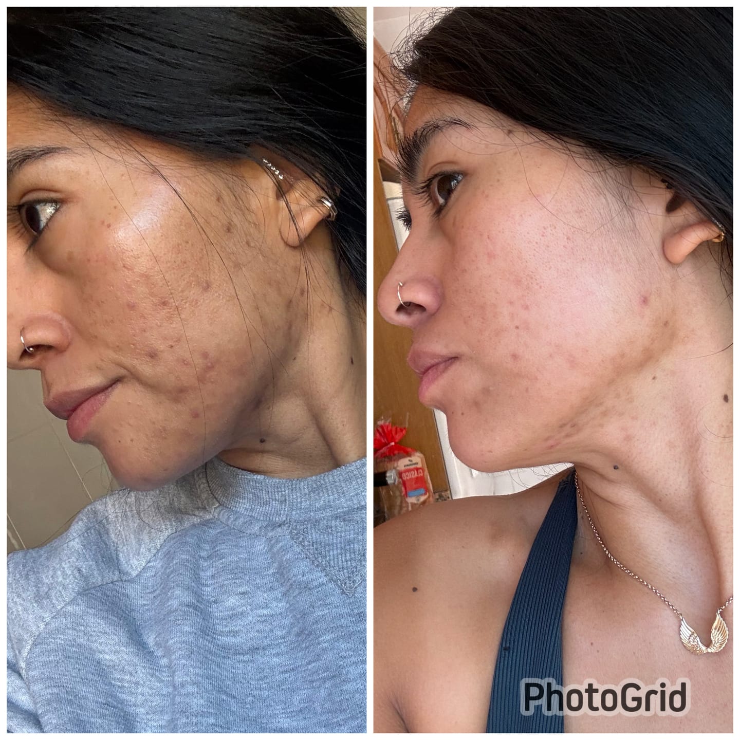 Customer photo review of A CONTROL - ACNÉ HORMONAL & RESISTENCIA A LA INSULINA