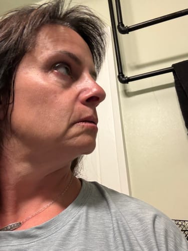 Customer's face in profile before using the Seranova Micro Infusion System, showing facial lines.