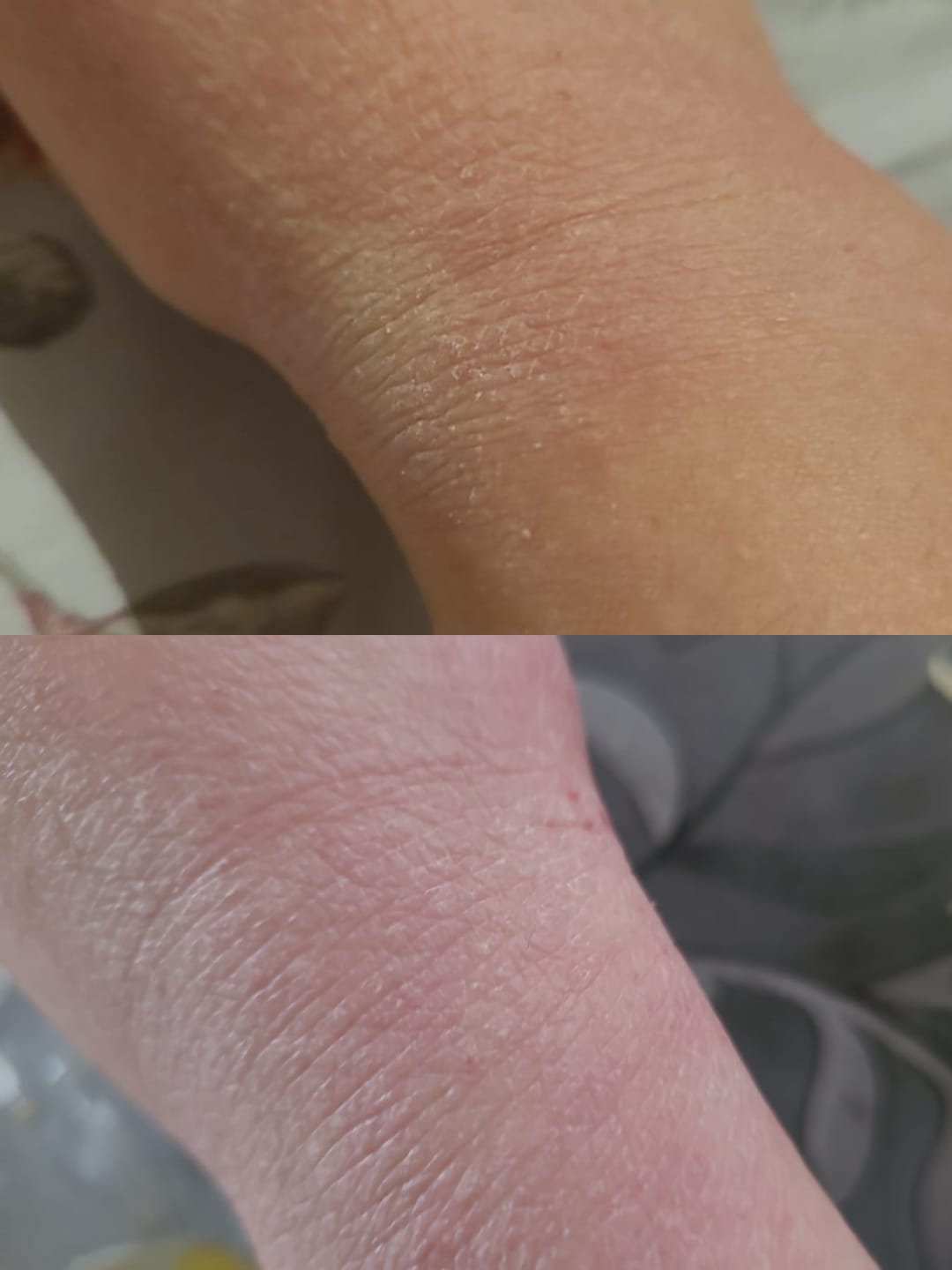 Customer photo review of Eczema Scratch Mitten