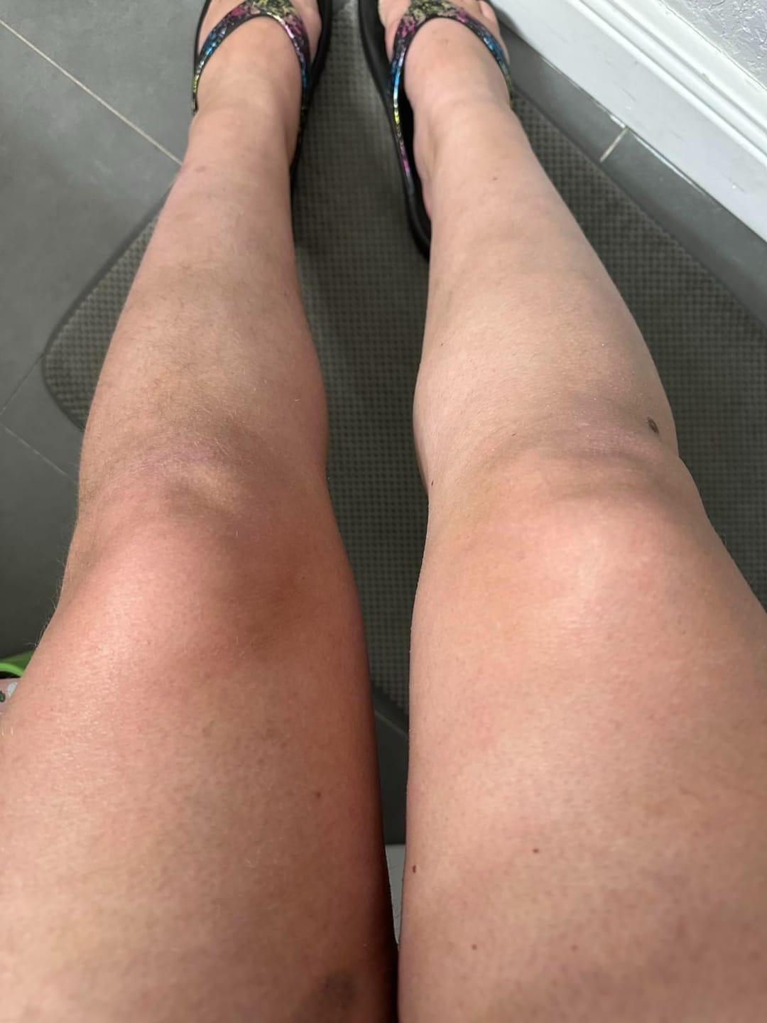 Customer photo review of SilkyLisse | Le Rasoir Féminin 2-en-1 Pour Zones Sensibles