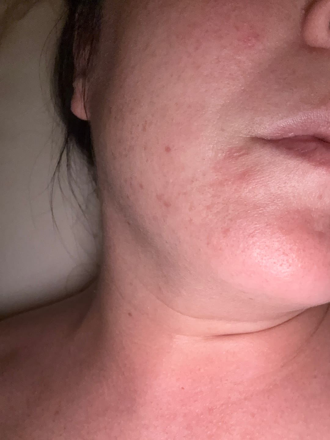 Customer photo review of A CONTROL - ACNÉ HORMONAL & RESISTENCIA A LA INSULINA