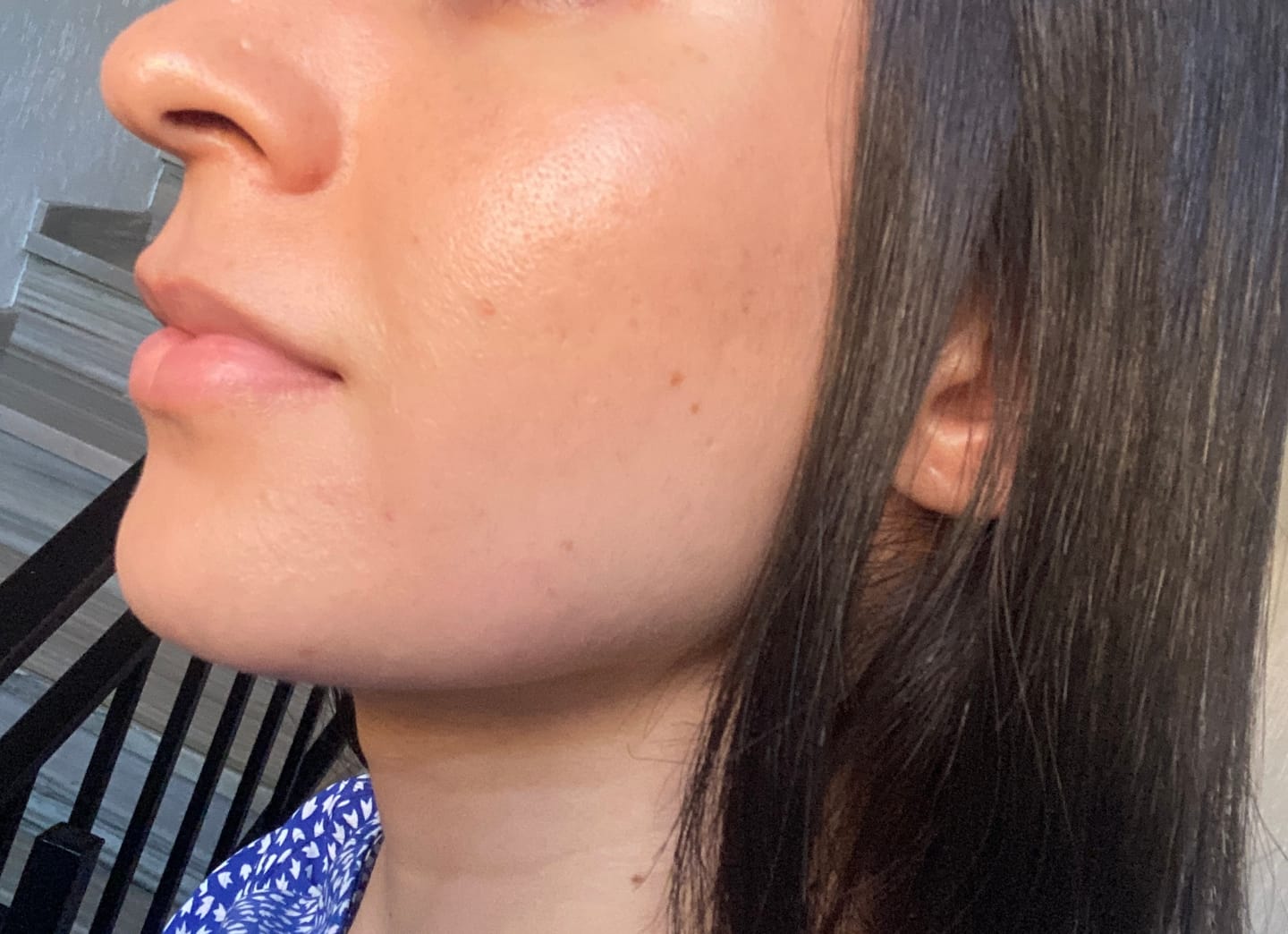Customer photo review of A CONTROL - ACNÉ HORMONAL & RESISTENCIA A LA INSULINA