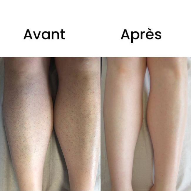 Customer photo review of Rasoio 2 in 1 per Bikini e Corpo Shape Up™