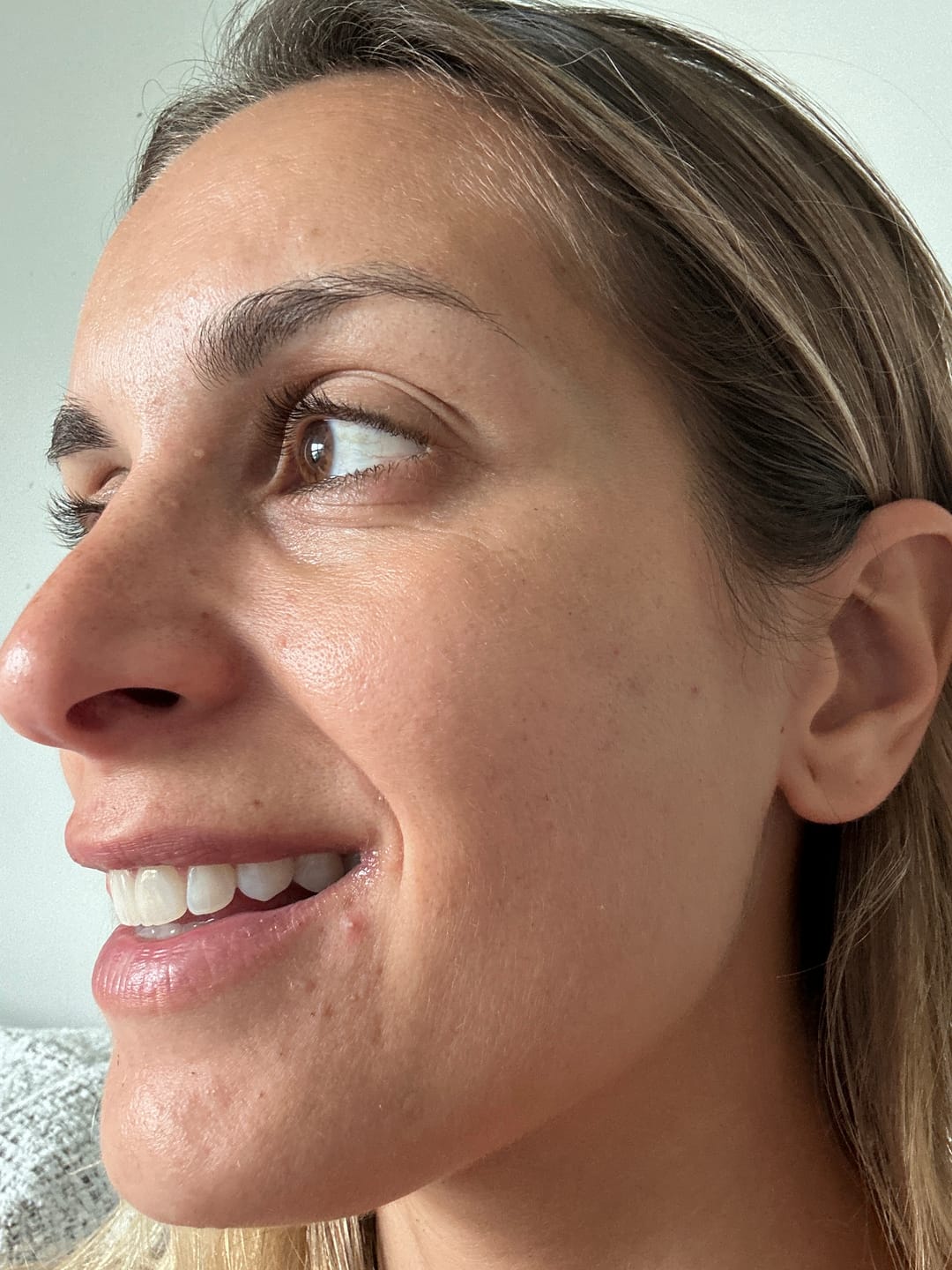 Customer photo review of A CONTROL - ACNÉ HORMONAL & RESISTENCIA A LA INSULINA