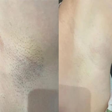 Customer photo review of Rasoio 2 in 1 per Bikini e Corpo Shape Up™