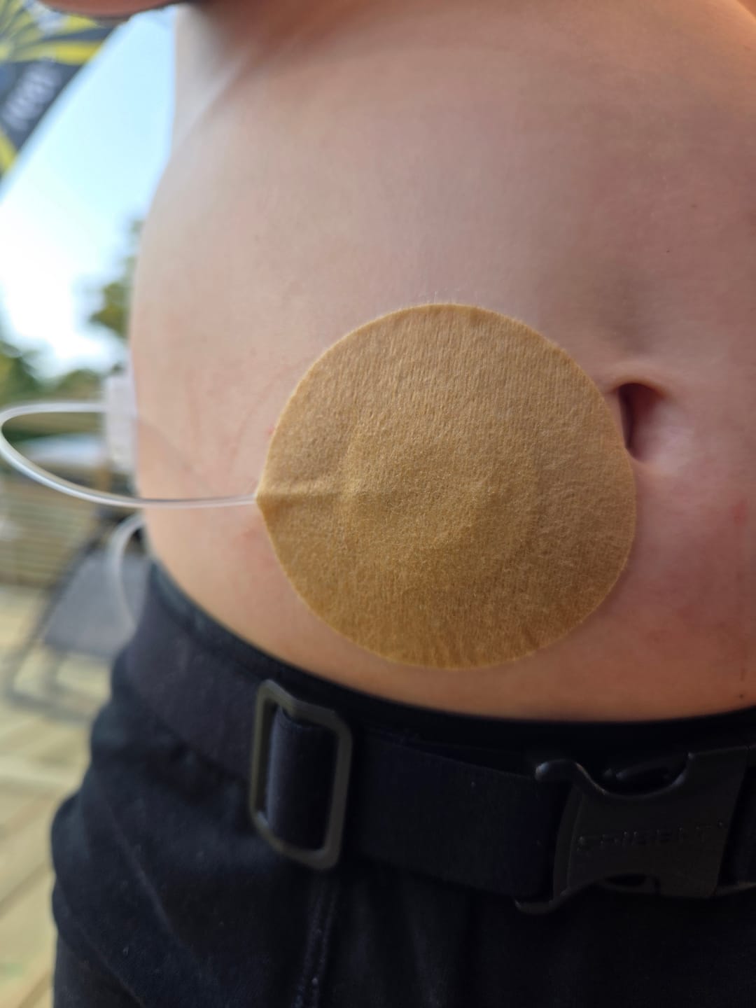 Customer photo review of TruSteel™ Infusionsset Patches – Hudvänliga och Stabilt Fäste
