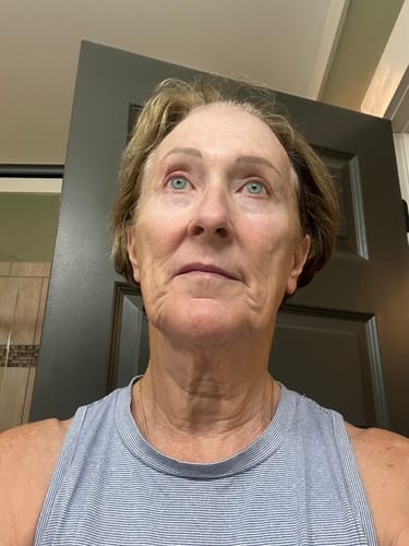 Customer's face before the first application of The Micro Infusion System, showing skin with fine lines.