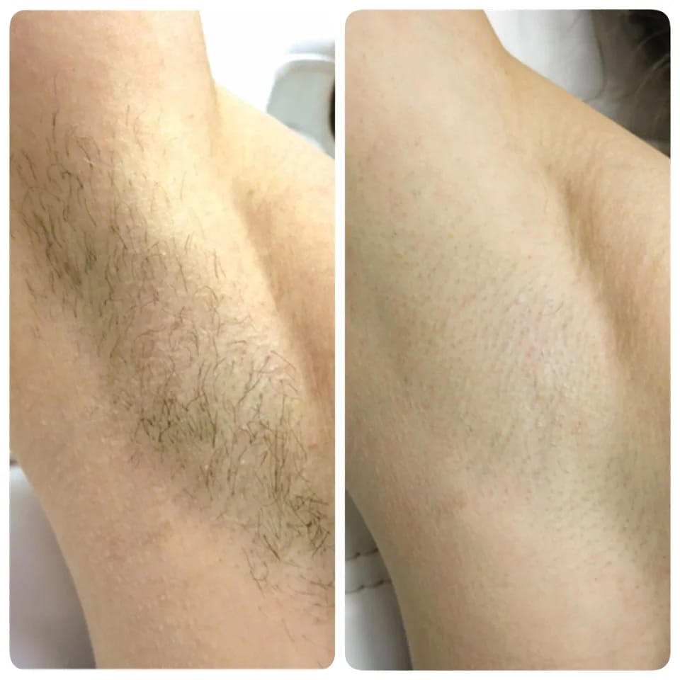 Customer photo review of Rasoio 2 in 1 per Bikini e Corpo Shape Up™