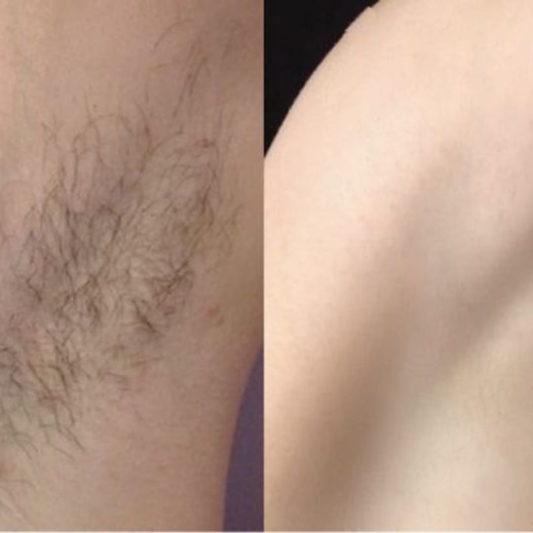 Customer photo review of Rasoio 2 in 1 per Bikini e Corpo Shape Up™