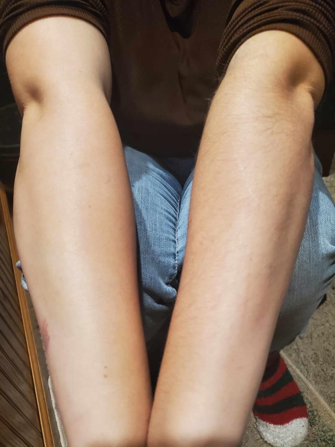 Customer photo review of SilkyLisse | Le Rasoir Féminin 2-en-1 Pour Zones Sensibles