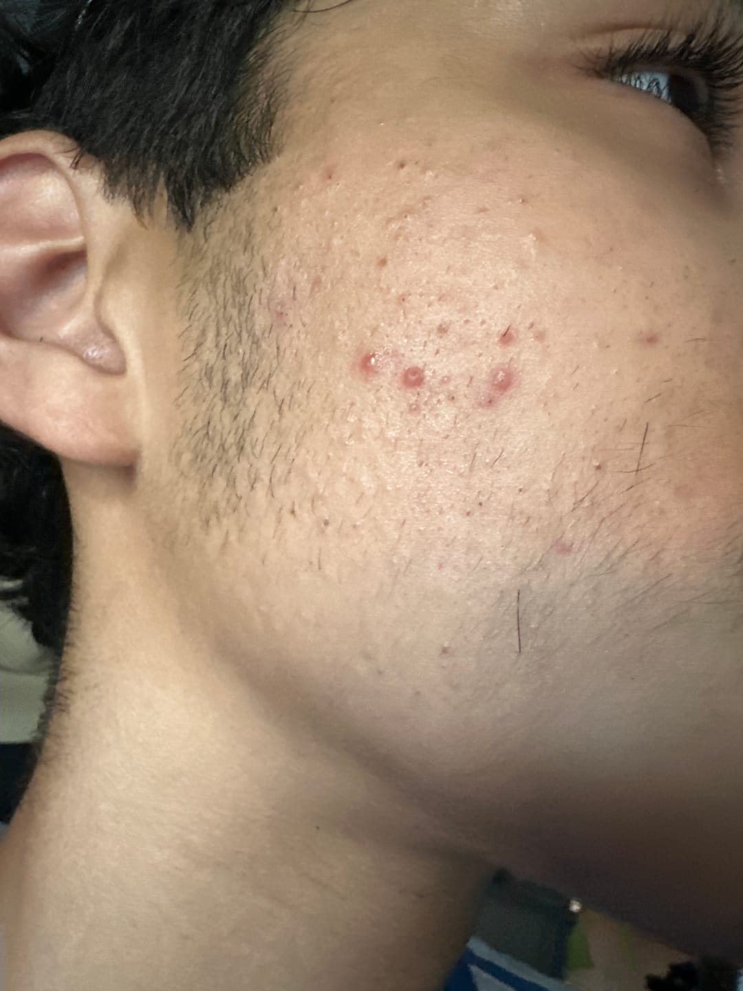 Customer photo review of Acne Drying Lotion Plus — 2 Pack (20 mL × 2)