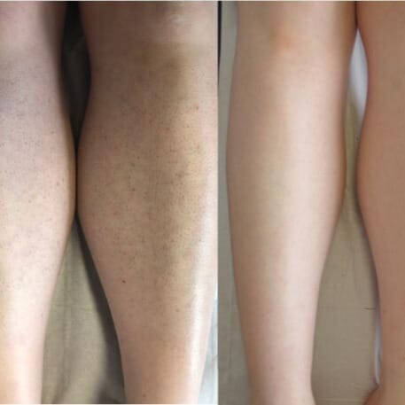 Customer photo review of Rasoio 2 in 1 per Bikini e Corpo Shape Up™
