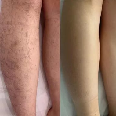 Customer photo review of Rasoio 2 in 1 per Bikini e Corpo Shape Up™