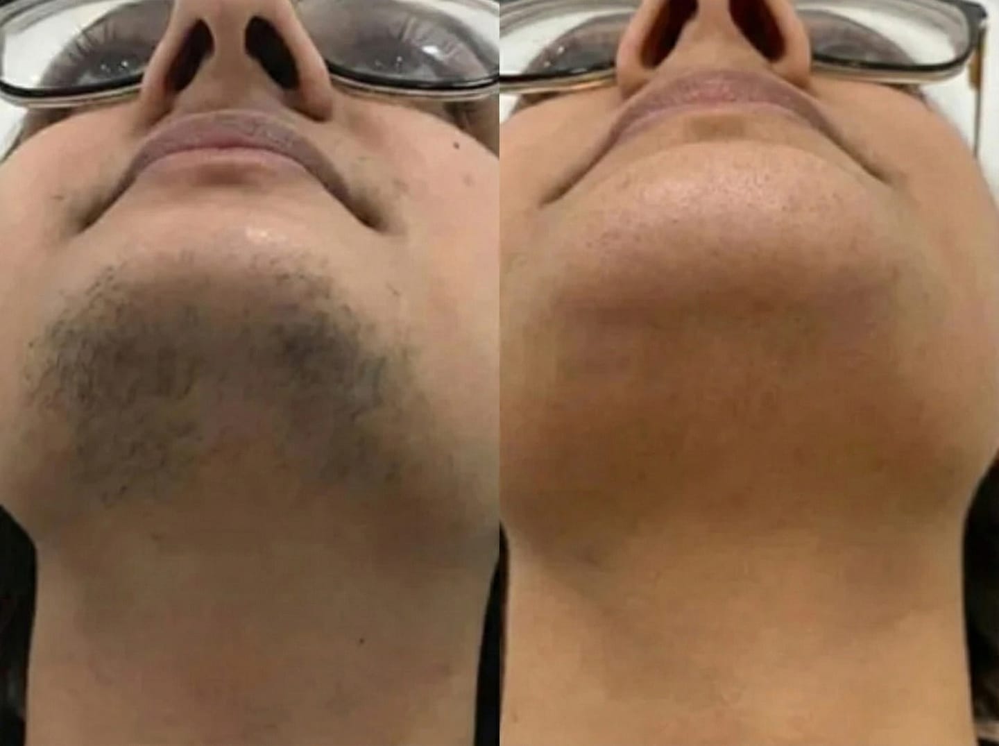 Customer photo review of Rasoio 2 in 1 per Bikini e Corpo Shape Up™