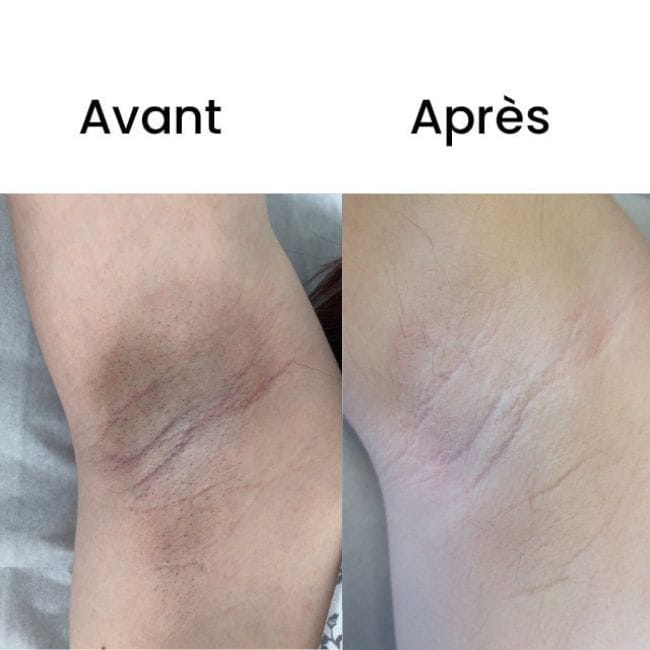 Customer photo review of Rasoio 2 in 1 per Bikini e Corpo Shape Up™