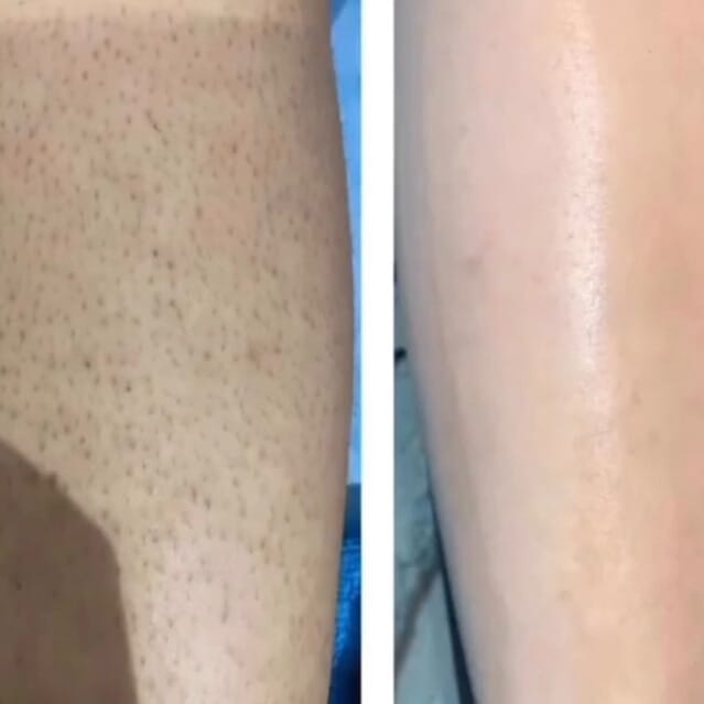 Customer photo review of Rasoio 2 in 1 per Bikini e Corpo Shape Up™