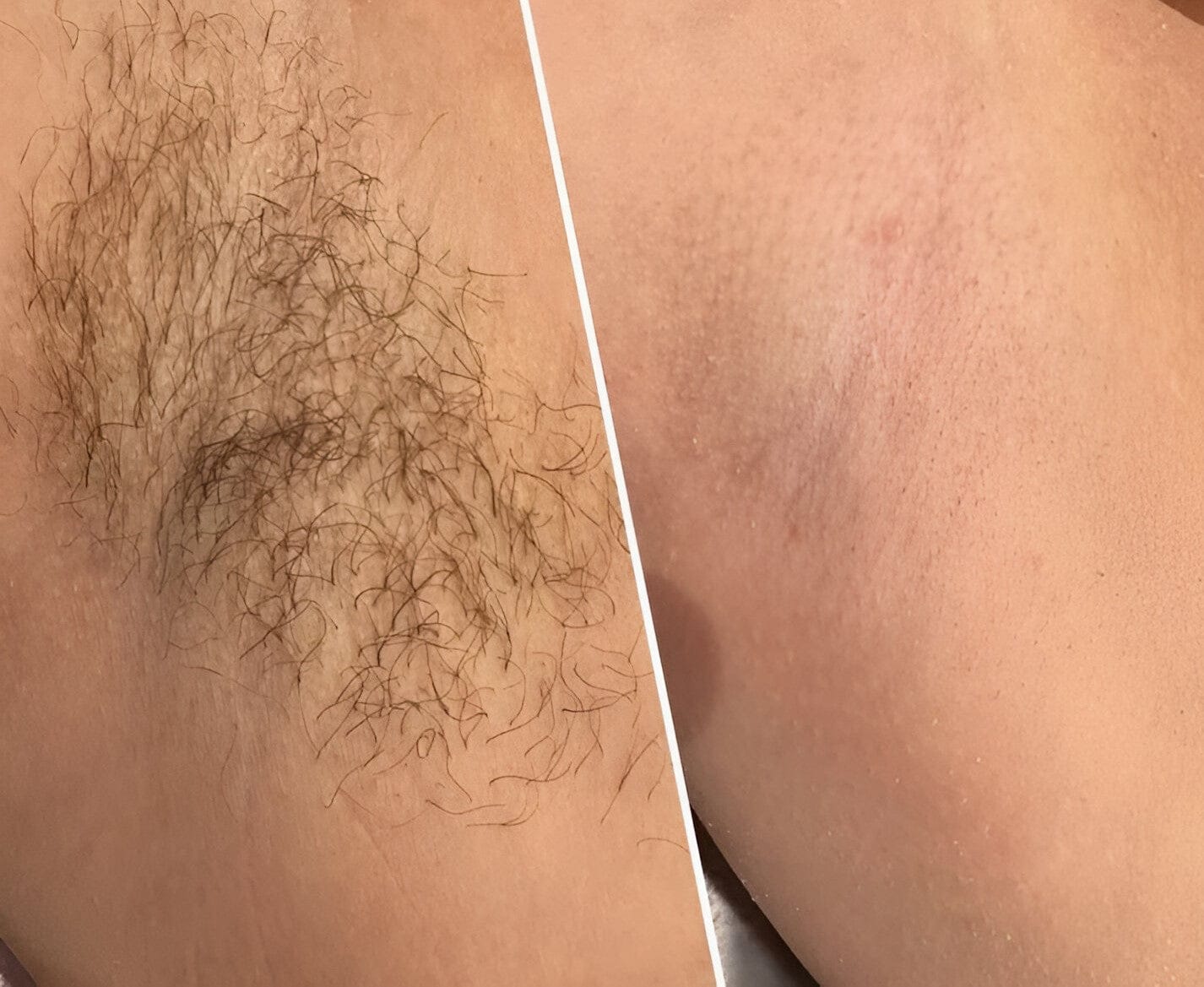Customer photo review of SilkyLisse | Le Rasoir Féminin 2-en-1 Pour Zones Sensibles