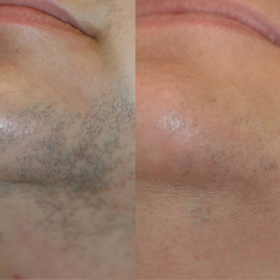 Customer photo review of Rasoio 2 in 1 per Bikini e Corpo Shape Up™