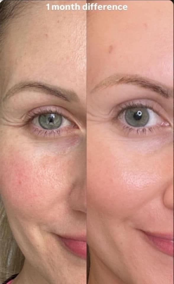 Customer photo review of LUMORA TXA + Niacinamide Capsule Cream