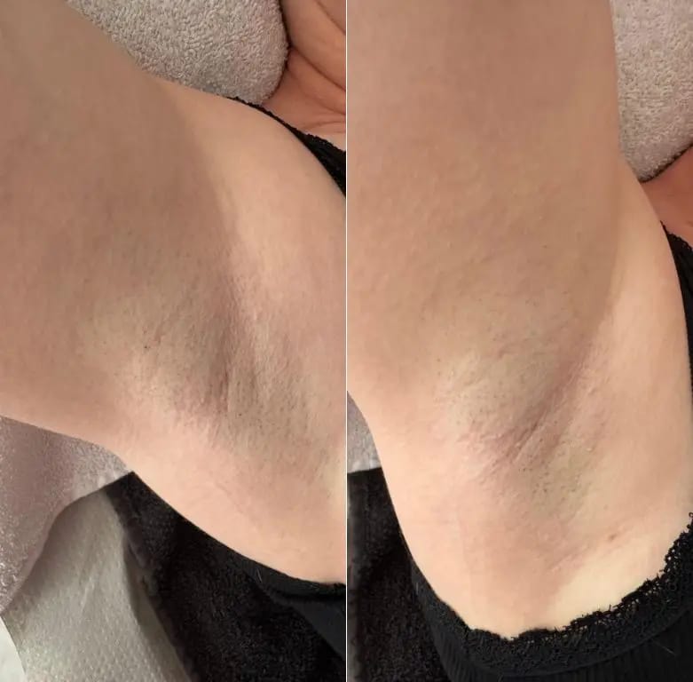 Customer photo review of Rasoio 2 in 1 per Bikini e Corpo Shape Up™