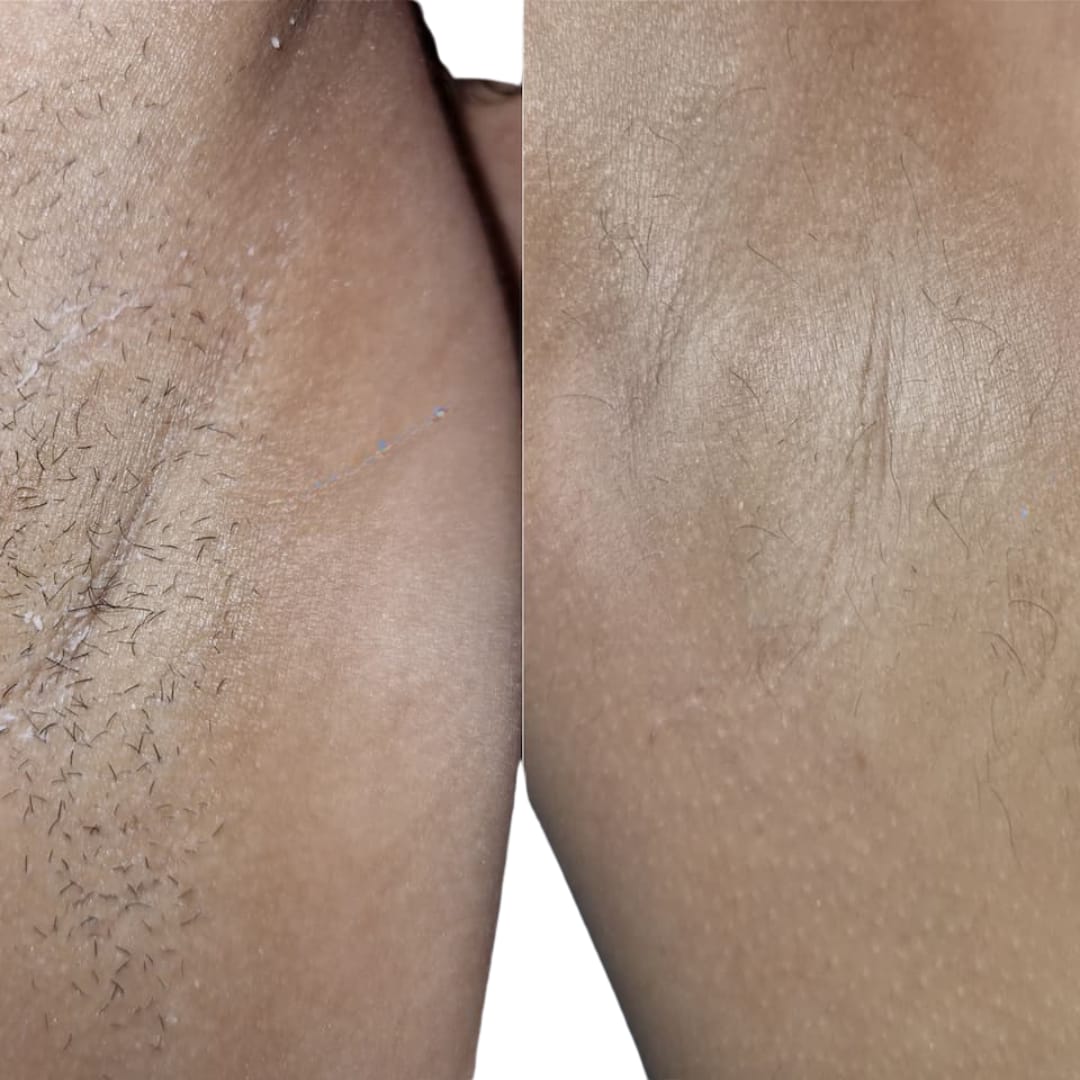 Customer photo review of Rasoio 2 in 1 per Bikini e Corpo Shape Up™
