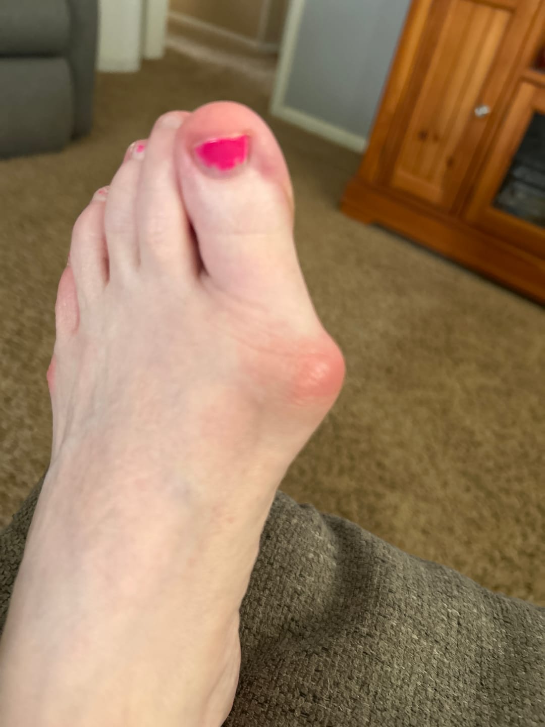 Customer photo review of Treatmedy™ Bunion Fix