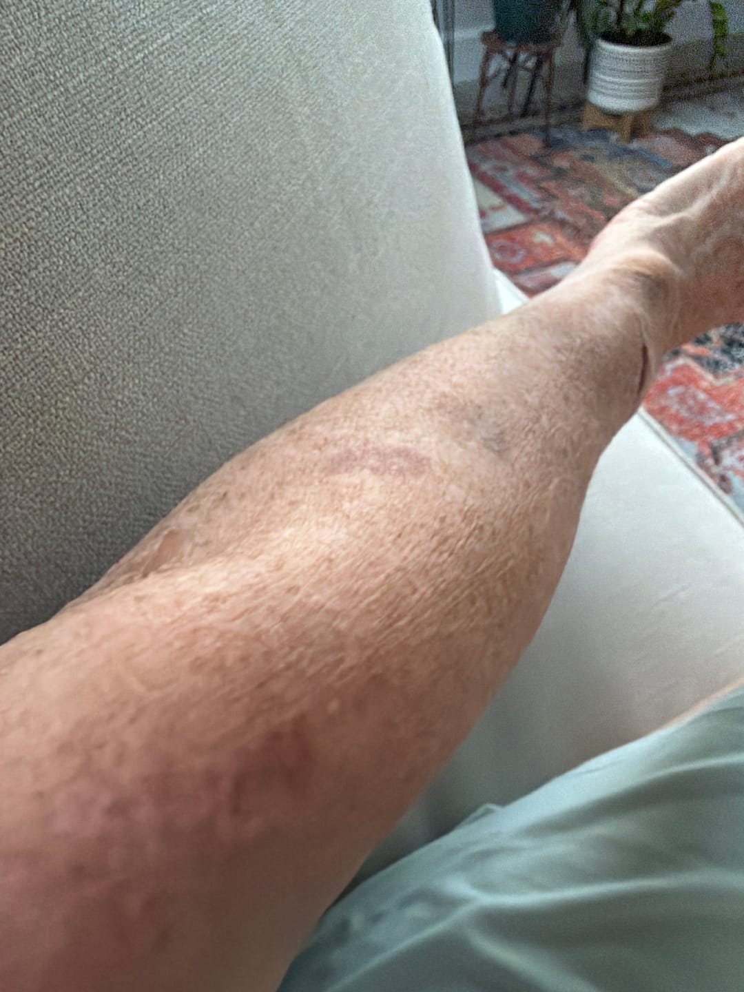 Customer photo review of Arnica Montana + Vitamin K Cream