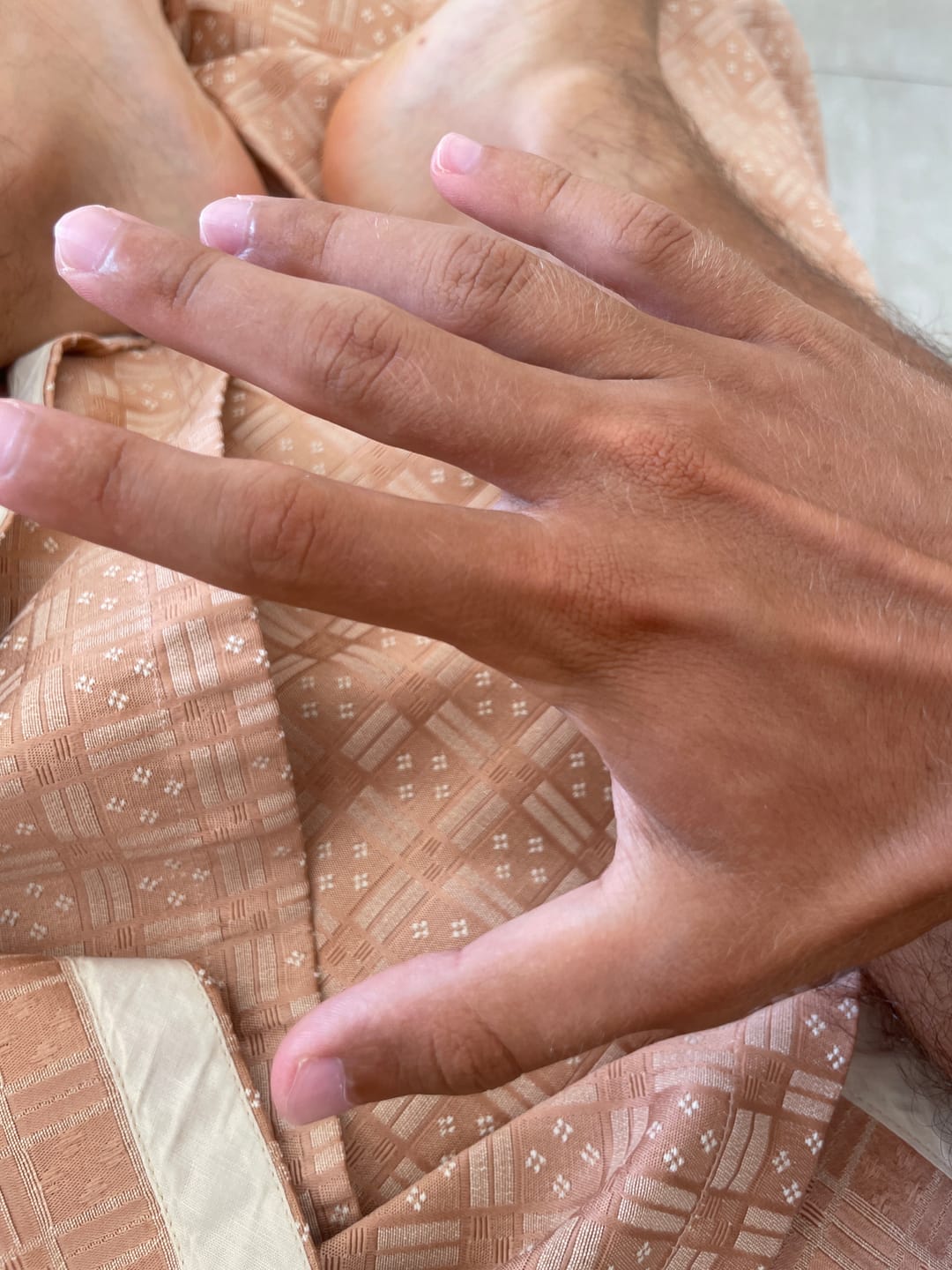 Customer photo review of Eczema Scratch Mitten