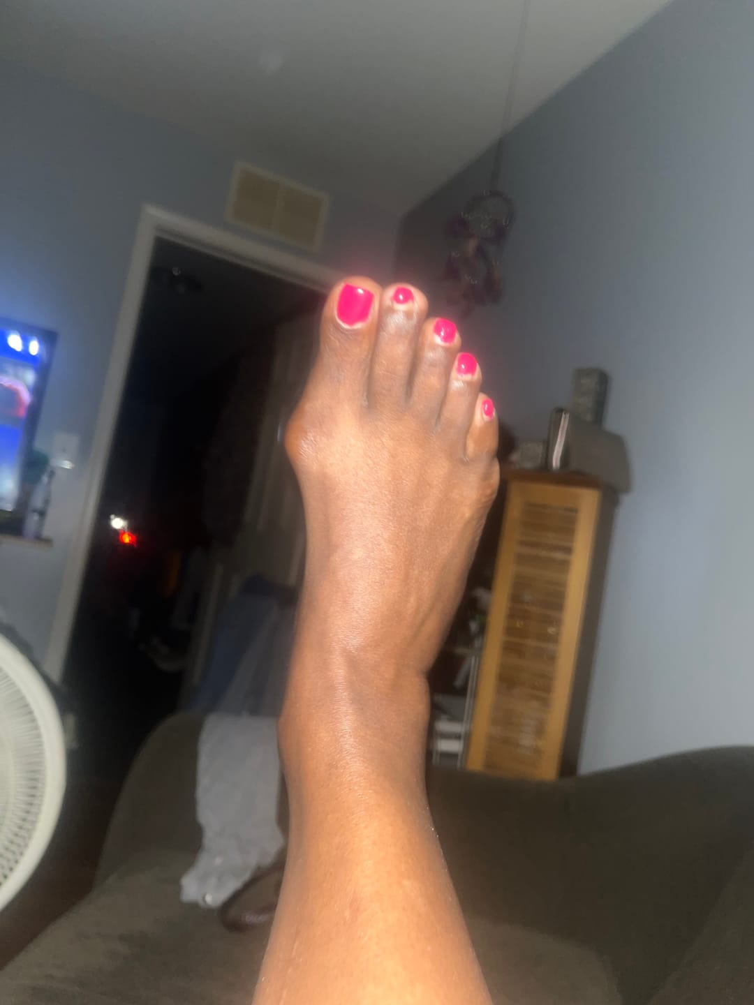 Customer photo review of Treatmedy™ Bunion Fix - Natural At-Home Bunion Relief
