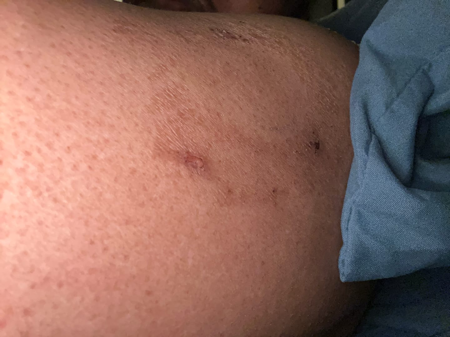 Customer photo review of Skin Grip Original - Freestyle Libre 2+ & Lingo Adhesive Patches