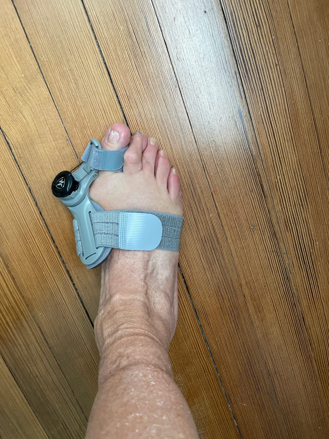 Customer photo review of Treatmedy™ Bunion Fix