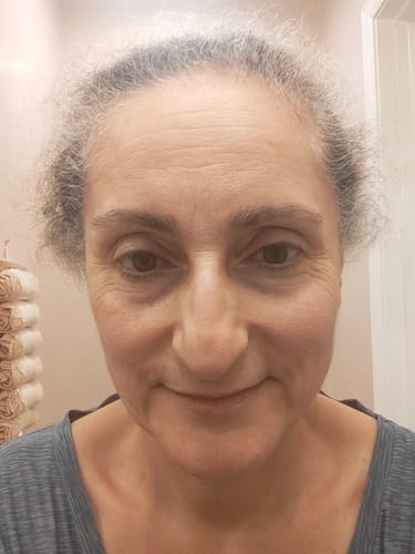 Reviewer shows their smooth and shiny face after using the Seranova Micro Infusion System.