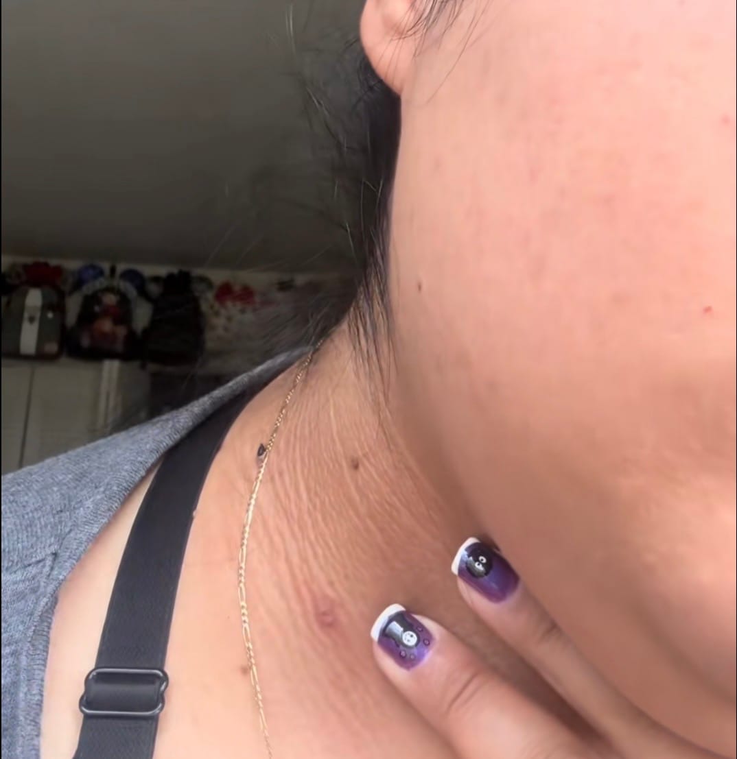 Customer photo review of Skin Tag Remover