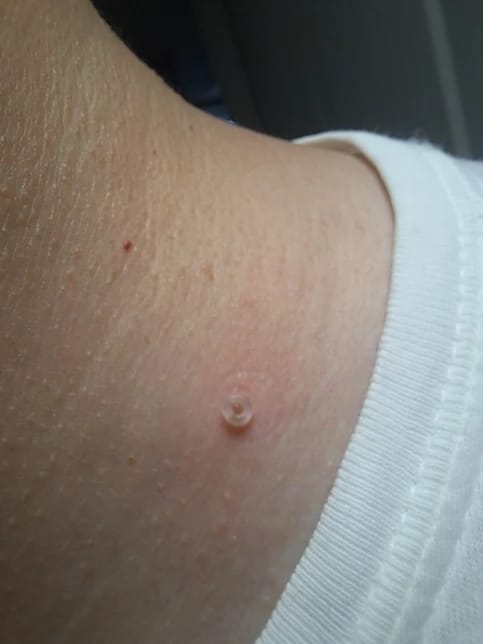 Customer photo review of Skin Tag Remover