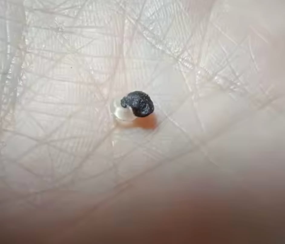 Customer photo review of Skin Tag Remover