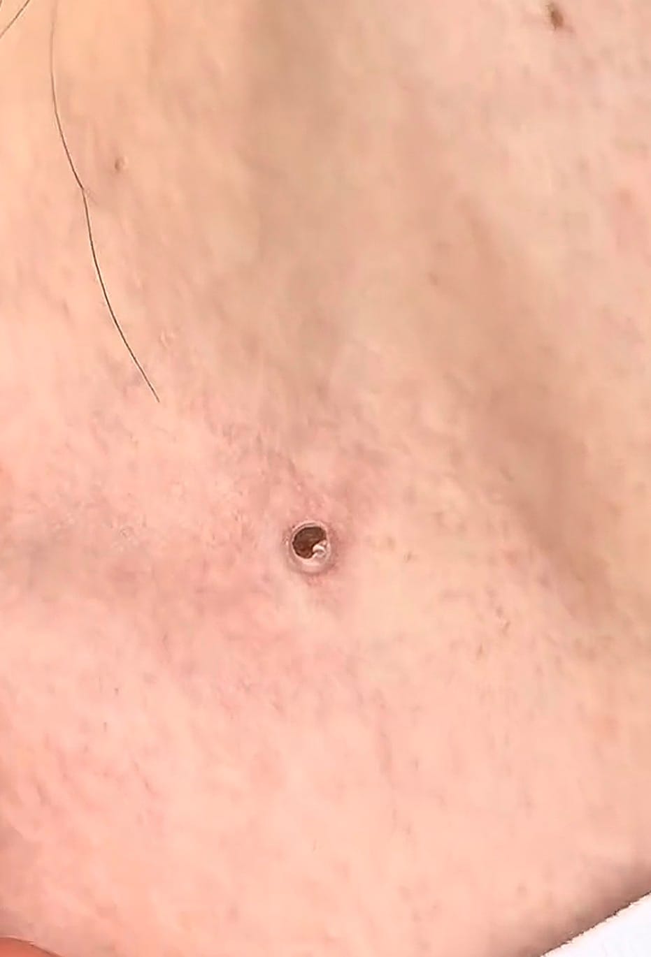 Customer photo review of Skin Tag Remover