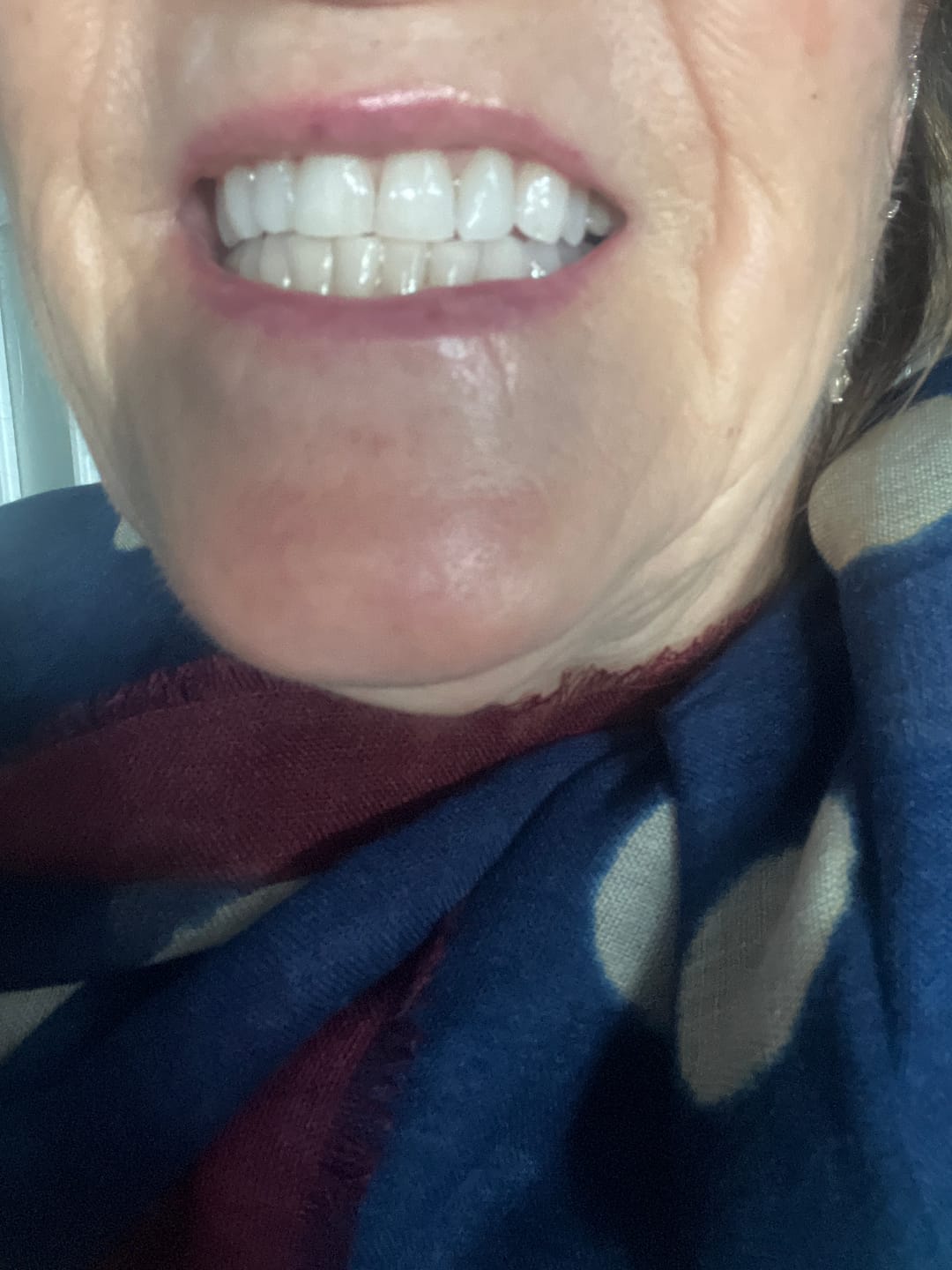 Customer photo review of Pack Ultime : Gel Violet + Bandes Blanchissantes