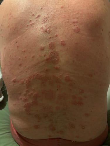 Customer showing the sore, itchy rash on a person's back before using Calm Balm, as mentioned in the review.