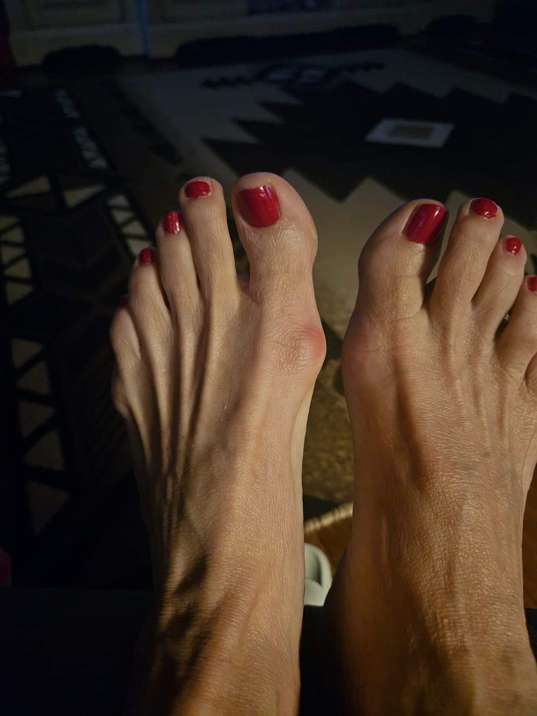 Customer photo review of Treatmedy™ Bunion Fix