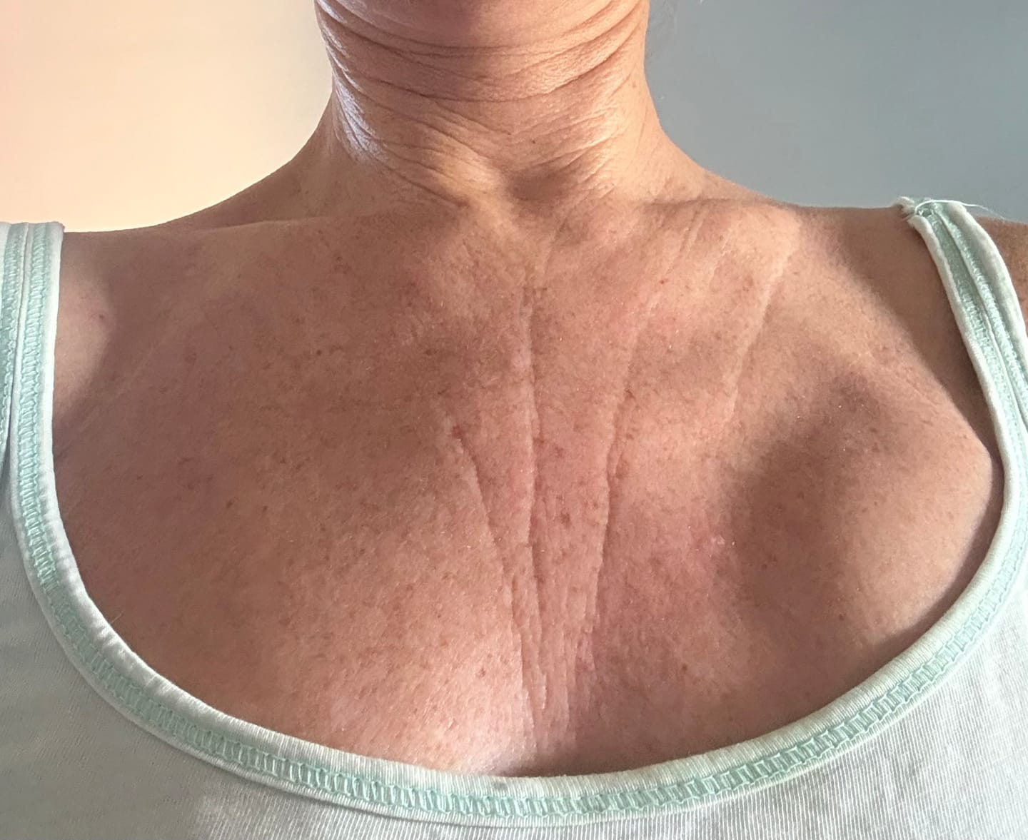 Customer photo review of Dekolleté Pad mit Hyaluron