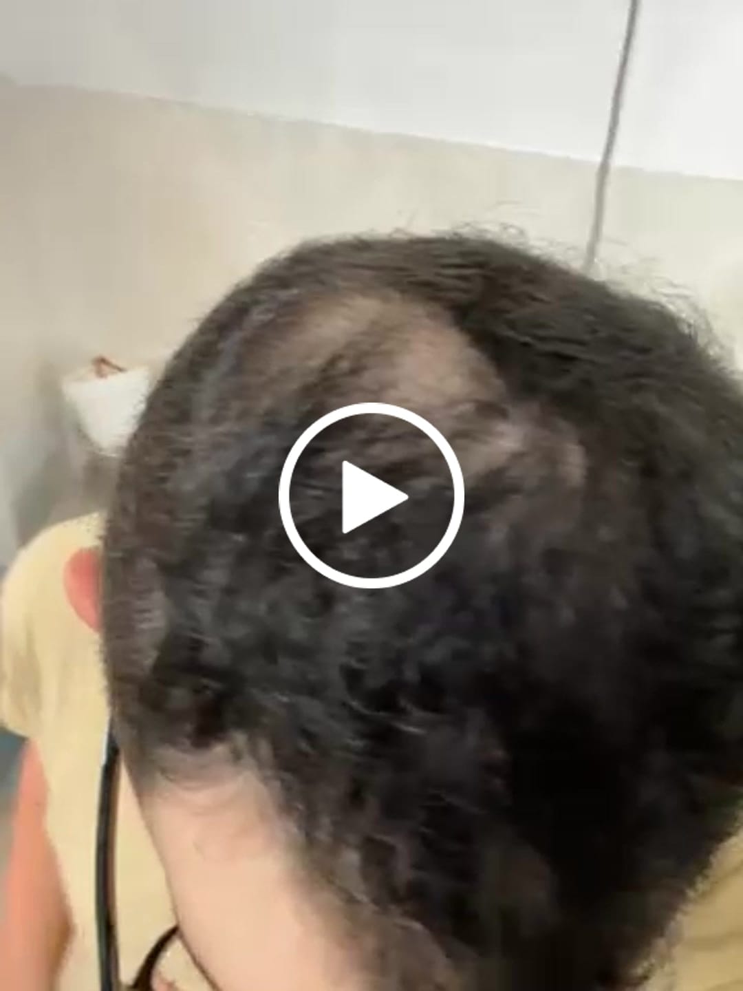 Customer video review of Fibre copri Calvizie da 12gr  | Castano Scuro | 30 Giorni di applicazioni