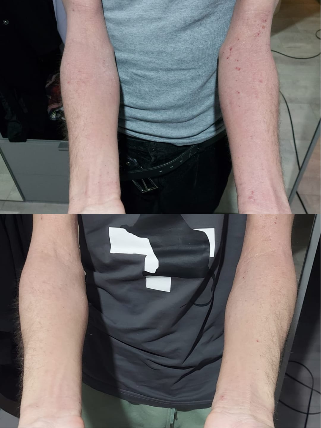 Customer photo review of Eczema Scratch Mitten