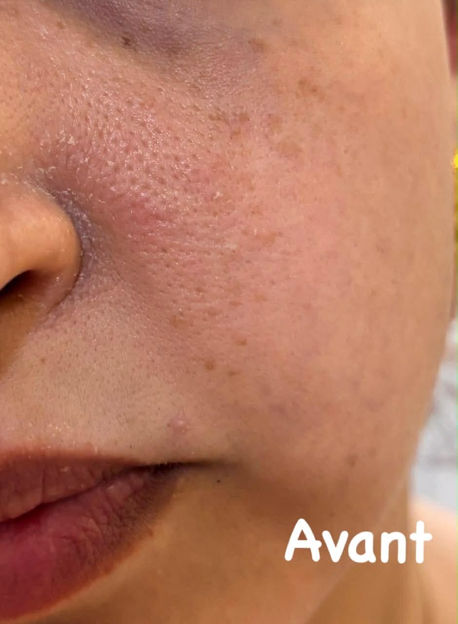 Customer photo review of ACIDE SALICYLIQUE 2% ULTRA PURE · HIGH POTENCY
