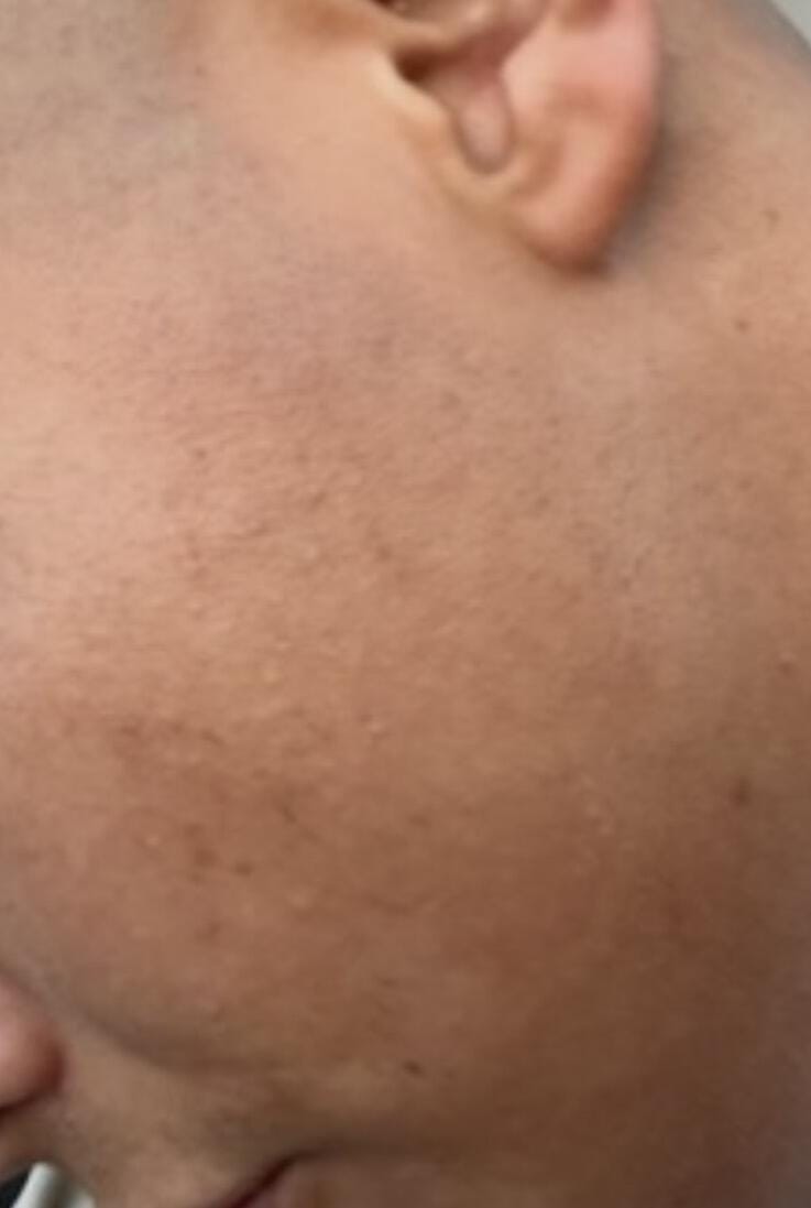 Customer photo review of Creamole - Natürliche Creme zur Entfernung von Muttermalen, Leberflecken & Warzen