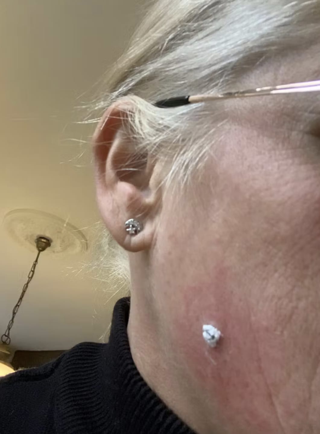 Customer photo review of Creamole - Natürliche Creme zur Entfernung von Muttermalen, Leberflecken & Warzen