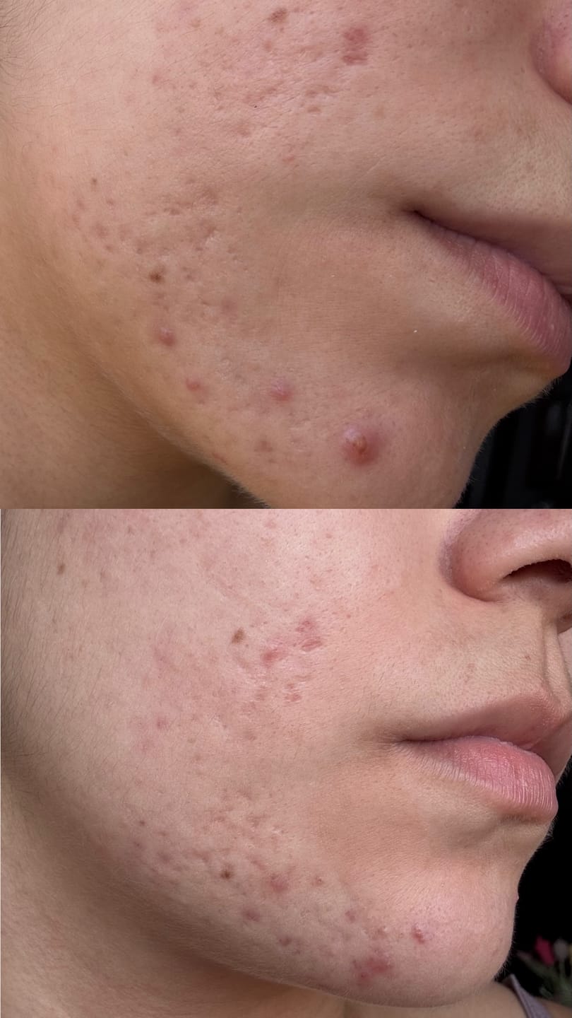 Customer photo review of A CONTROL - ACNÉ HORMONAL & RESISTENCIA A LA INSULINA