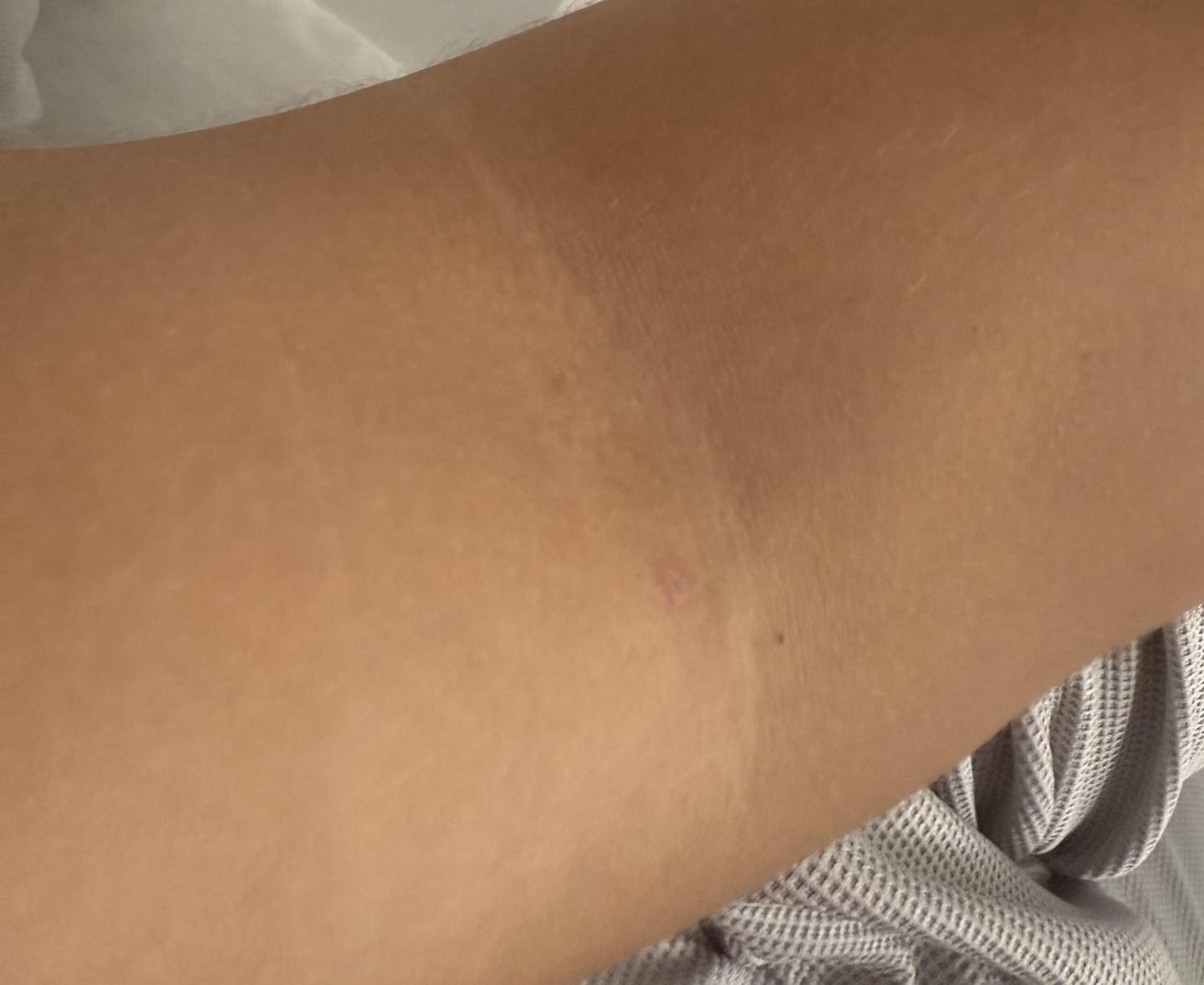 Customer photo review of Creamole - Natürliche Creme zur Entfernung von Muttermalen, Leberflecken & Warzen