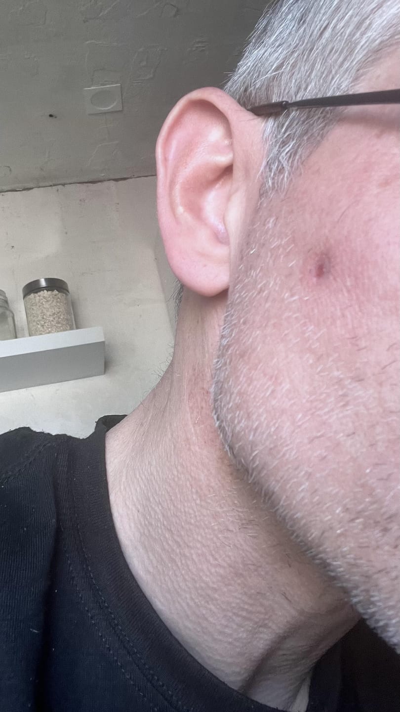 Customer photo review of Creamole - Natürliche Creme zur Entfernung von Muttermalen, Leberflecken & Warzen