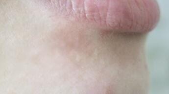Customer photo review of Creamole - Natürliche Creme zur Entfernung von Muttermalen, Leberflecken & Warzen